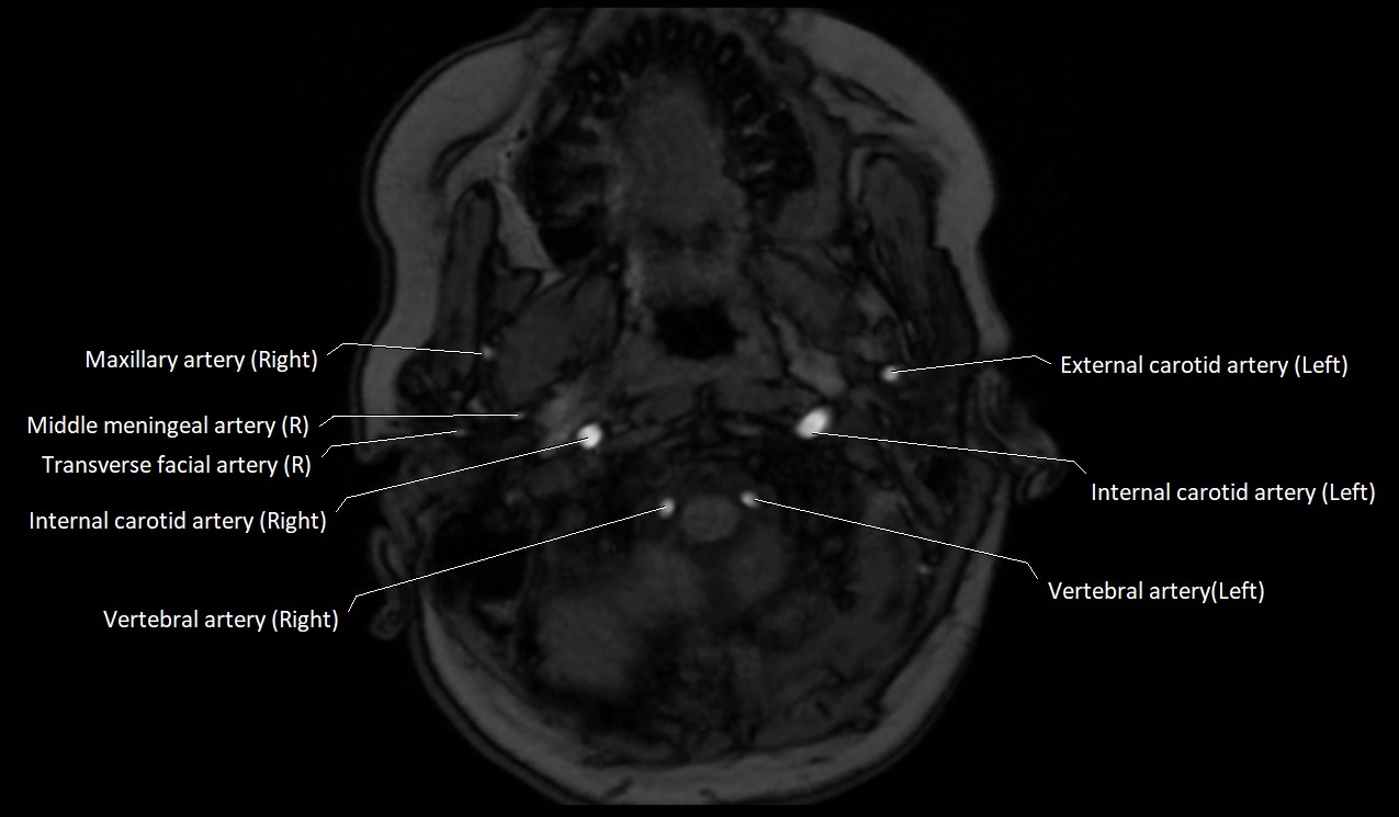 Carotid artery anatomy axial 3T image 5.jpg